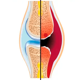Artikulazio osasuntsu eta higatu baten egitura kartilago-ehuna eta likido sinobiala izendatzen dituena