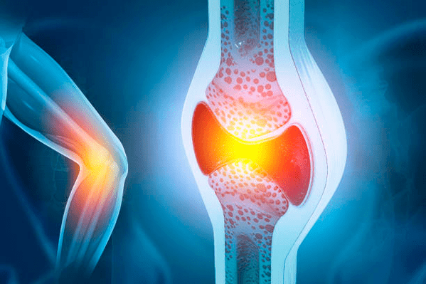 Artikulazioetako gaixotasunen prebentzioa
